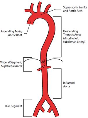 RACGP - Aortic aneurysms – screening, surveillance and referral