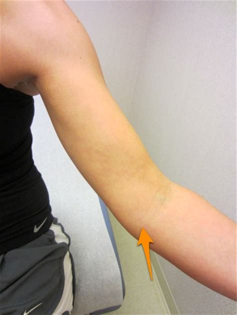 Golfer's Elbow – Medial Epicondylitis | Dr Geier