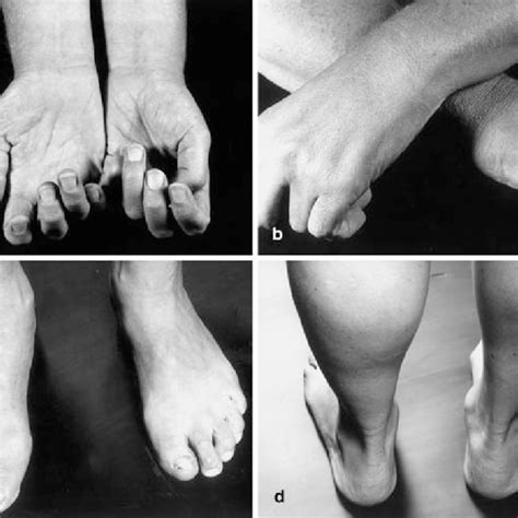 (PDF) [Multifocal motor neuropathy: diagnosis and differential diagnosis].