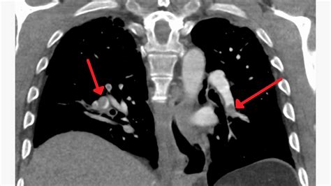 Can You Drink Alcohol After Ct Scan With Contrast - calibretips