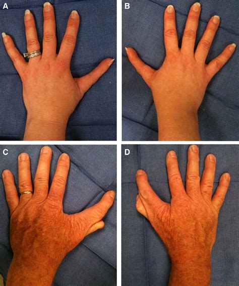 clinical pedigree of the twin boys with bilateral triphalangeal thumbs.... | Download Scientific ...