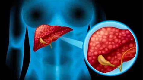 Best treatment options for Liver Cancer and its advanced therapies