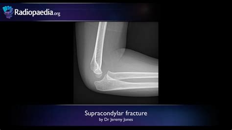 Supracondylar fracture - radiology video tutorial (x-ray) 0-0 ...