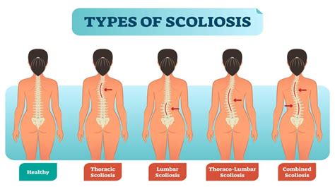 Scoliosis 101 – HealthWorks