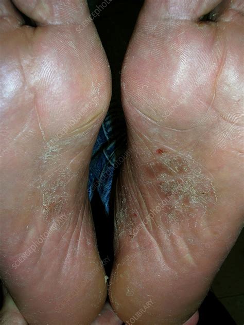 Atypical palmar plantar psoriasis - Stock Image - C056/4982 - Science Photo Library