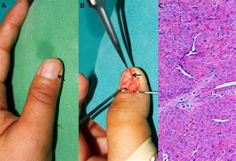 Glomus Tumor Nail Bed Symptoms - Nail Ftempo