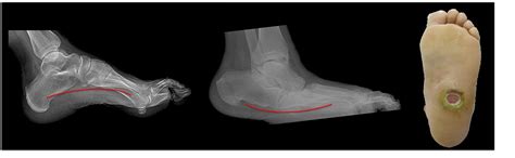 CHARCOT ANKLE CHARCOT FOOT SURGERY — Foot & Ankle Surgery