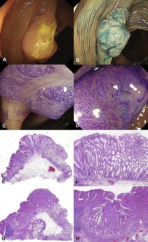 Distinct endoscopic characteristics of sessile serrated adenoma/polyp with and without dysplasia ...