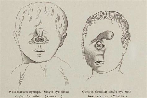 Cyclopia in Babies - What is it , Symptoms and Risk Factors - Being The Parent