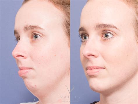 Chin Surgery