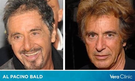 Al Pacino Bald: A Closer Look at His Hair and Personal Life