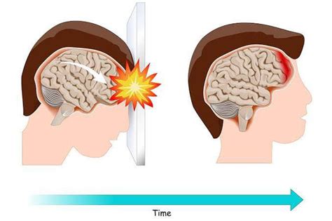 Contusion Cerebral