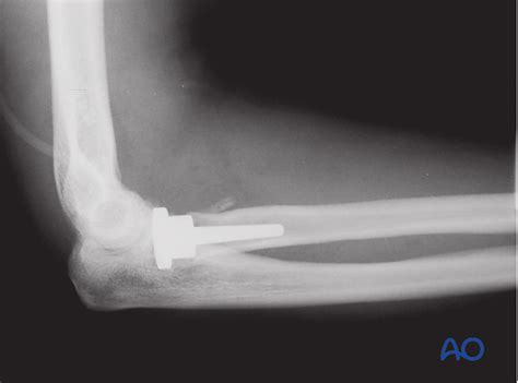 Radial head arthroplasty for Radius, complete articular