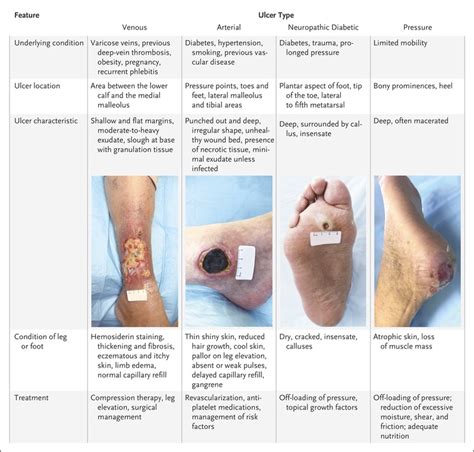 Venous Ulcer Vs Arterial Ulcer