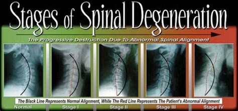 Cervical Degenerative Disc Disease: Causes, Symptoms, Treatment ...