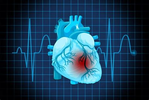 Understanding Costs of Catheter Ablation and HRU in PSVT Treatment