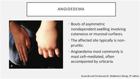 Hereditary Angioedema