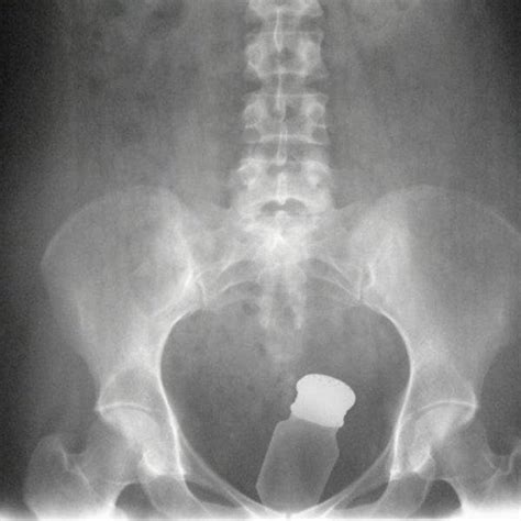 Weird Objects On X-Rays | Others