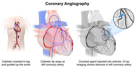 Coronary Artery Disease Evidence: Diet, Exercise | eHealthStar