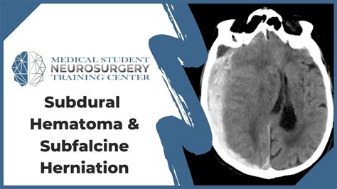 Subfalcine Herniation