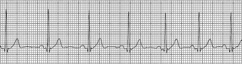 Sinus Dysrhythmia - equimedcorp