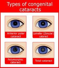 Types of Cataracts | Brooks Eye Associates