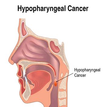 HYPOPHARYNGEAL CANCER MANAGEMENT - headneckcancerspecialist