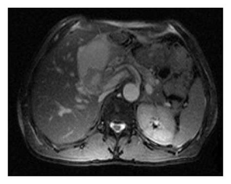 Ultrasonography scan of liver showing multilocular anechoic cystic... | Download Scientific Diagram