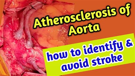 Atherosclerosis Abdominal Aorta Treatment