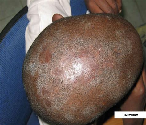 Ringworm (Dermatophytosis)- Causes, Symptoms, Treatment, Diagnosis and ...