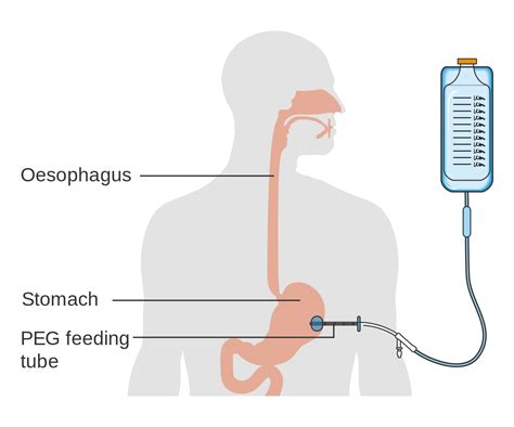 HOME TUBING- PEG tube TRACH tube, can Families Cope? | Enayati