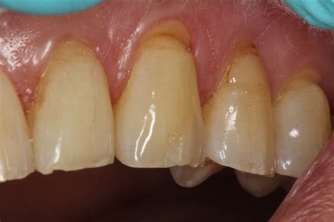 Seamless Incisal Edge Repair Using OMNICHROMA Composite