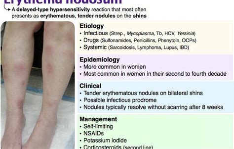 Medical treatments for erythema nodosum – Healthy Food Near Me