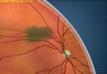 Choroidal Nevus Treatment Orange County | Atlantis Eyecare