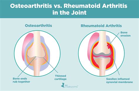 Osteoarthritis May Have More Comorbidities Than Rheumatoid Arthritis