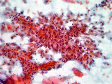 Cytopathology of lymph nodes-FNAC – Cellnetpathology.com