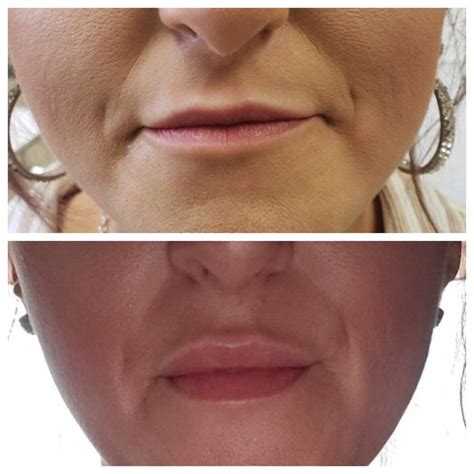 Botox Lip Flip | Botox lips, Botox, Aesthetic dermatology