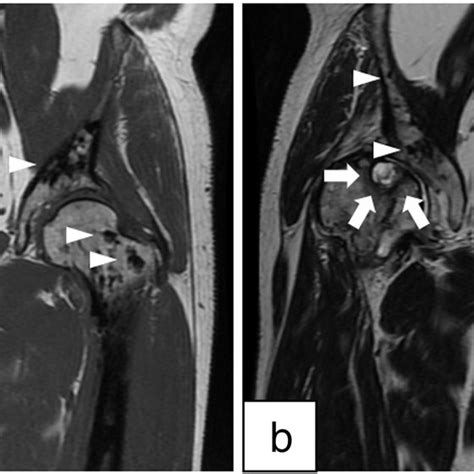 Coronal MRI of Both Hips. A subchondral cyst within the right femoral... | Download Scientific ...