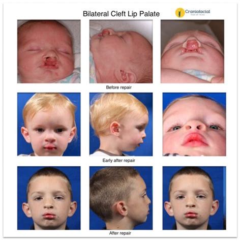 Bilateral-cleft-Lip-palate-5 - Dell Children's Craniofacial Team of Texas