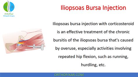 Iliopsoas Bursitis Injection