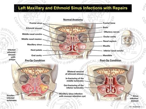 Maxillary And Ethmoid Sinus Disease