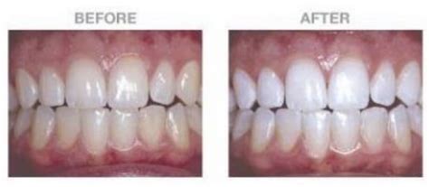 Opalescence Boost Teeth Whitening: How it Works and How Much it Costs ...