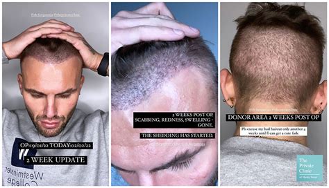 Hair Growth after Hair Transplant | After Follicular Transfer FUE Hair Transplant (2022)