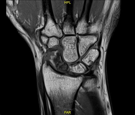 Scaphoid Fracture Mri