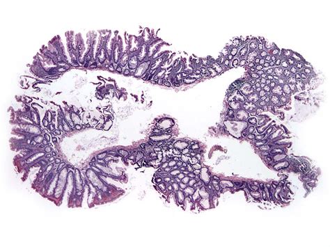 Pathology Outlines - Sessile serrated adenoma