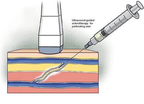 Varicose Vein Treatment: Ultrasound Guided Sclerotherapy | Midwest Vein Care