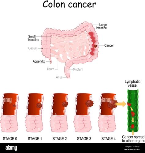 colon cancer. Colorectal oncology. Development of a malignant tumor ...