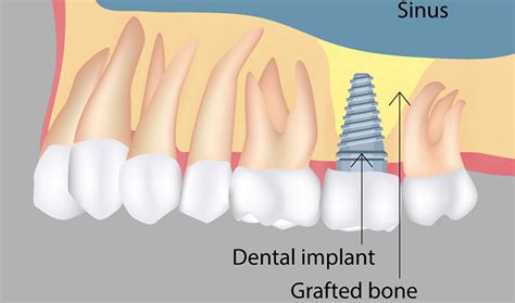 Teeth Club - Bone Graft & Sinus Lift