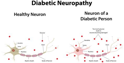 Diabetic Neuropathy Causes, Symptoms, Diagnosis And Treatment - Natural Health News