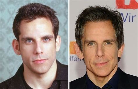 Ben Stiller Before and After Plastic Surgery: Ears, Nose, Face